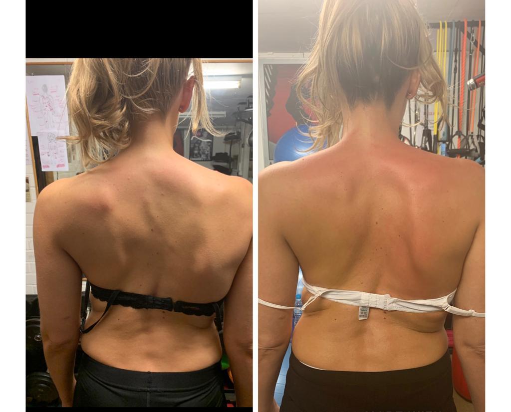 Paul scoliosis image2